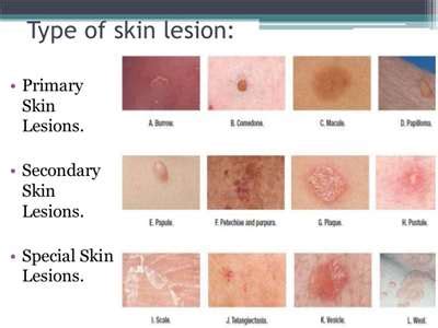 Identifying Skin Lesions