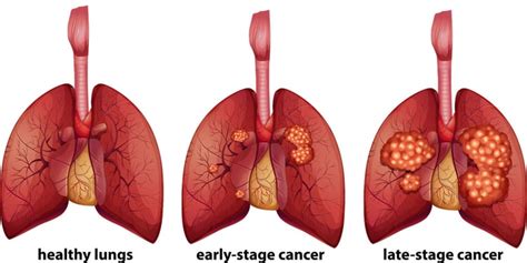 Staging of Lung Cancer | Lung Cancer Stages