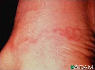 Cutaneous larva migrans - wikidoc