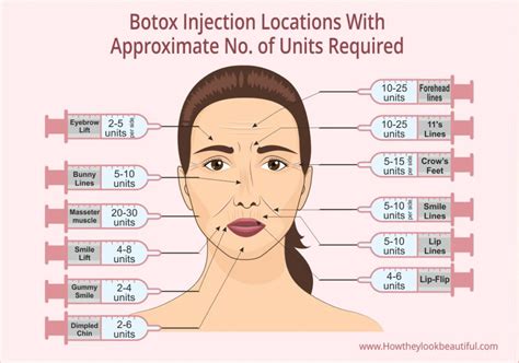 Where on Your Face Can You Get Botox Injected? (With Units)