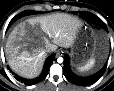 Liver Atlas: Diagnosis: Laceration