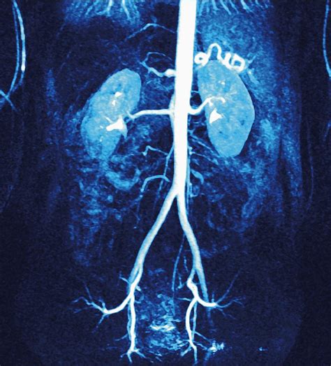 Normal Renal Arteries, Mra Scan Photograph by Miriam Maslo