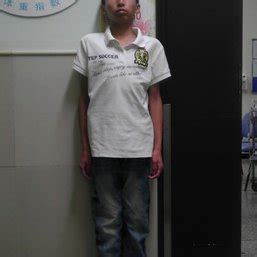 The patient at 16 years of age, 149 cm tall and 30 kg in weight. He had ...