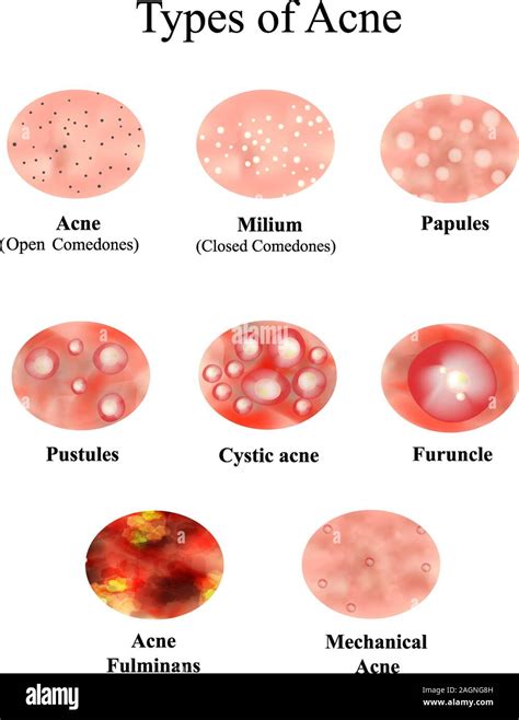 15+ Cystic Acne Diagram Pictures - Acne problems