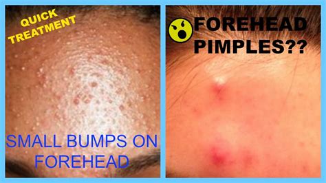 Acne Home Remedies For Dry Skin: Forehead Pimples Home Remedies