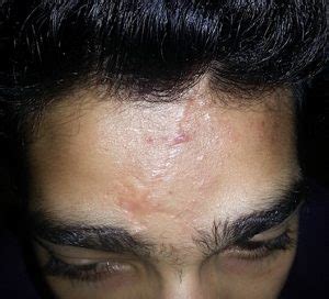 forehead scar revision result Dr Barry Eppley Indianapolis - Explore Plastic Surgery