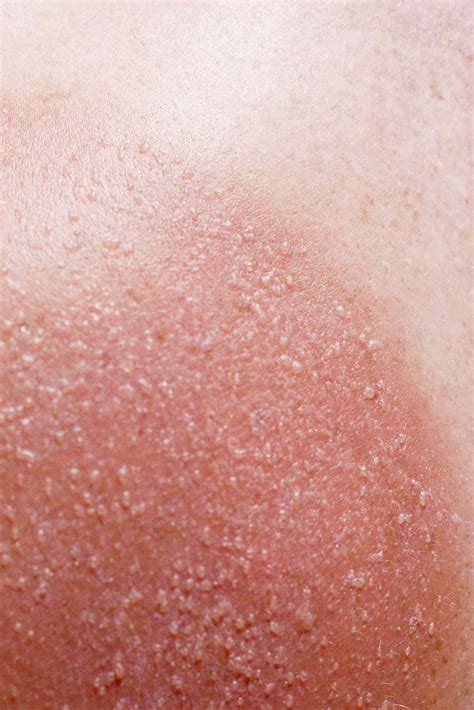 The Sun Poisoning Symptoms You Should Know—and How to Treat Them | Health.com