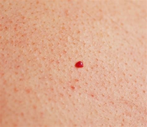 Cherry Angiomas - Pictures, Symptoms, Causes, Treatment, Removal | HubPages