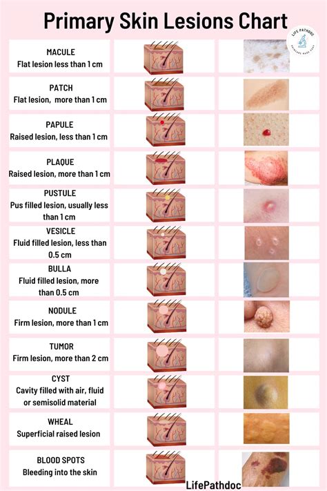 Skin Lesions: Types with Chart, Pictures, Causes, Treatment