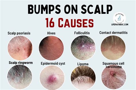 Bumps on the Scalp: 16 Causes, Pictures, and Treatment