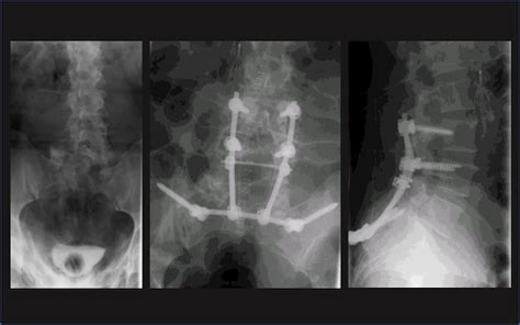 Sacrum fracture