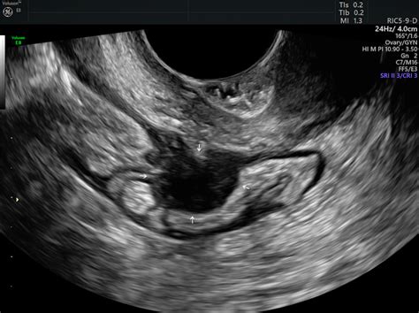 Diagnosing Endometriosis by Comparing Ultrasound & MRI | Empowered ...