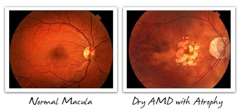 Dry & Wet AMD - Signs, Symptoms, and Diagnosis - Cure AMD Foundation