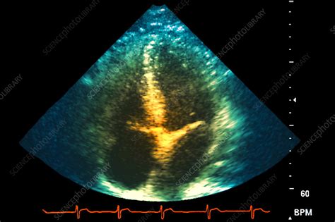 Normal heart, ultrasound scan - Stock Image - P216/0476 - Science Photo Library