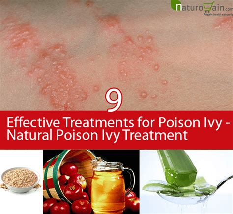 Natural Poison Ivy Treatment - 9 Effective Treatments for Poison Ivy