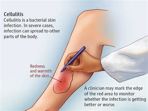 Best Cellulitis Treatment Doctor in Madurai, Tamil Nadu | Madurai Footcare Centre