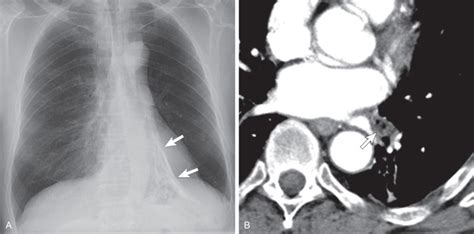 Pulmonary Hamartoma | Radiology Key