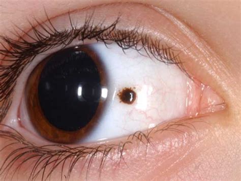 Ocular Melanoma Pictures – 27 Photos & Images / illnessee.com