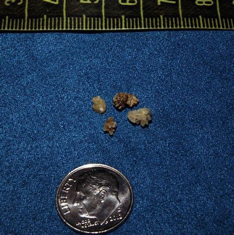 Kidney Stones - Durward Black, MD