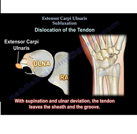 Extensor Carpi Ulnaris Subluxation — OrthopaedicPrinciples.com