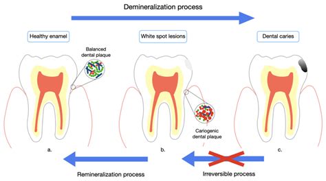 Demineralization And Remineralization Dynamics And Dental, 49% OFF