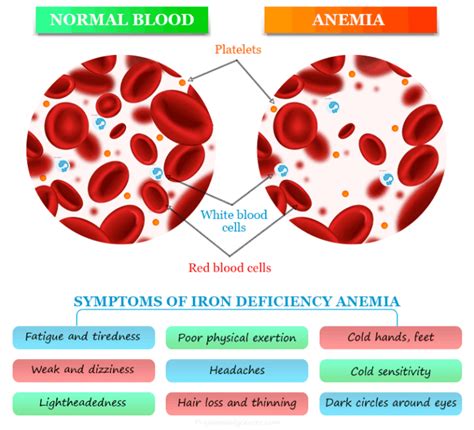 Iron Deficiency Anemia Symptoms And Treatment – NBKomputer