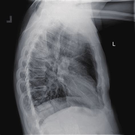 Valves On Lateral Chest X Ray