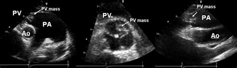 Transthoracic echocardiography at the level of the pulmonary valve... | Download Scientific Diagram