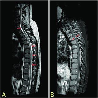 Brain MRI. T1 weighted MRI scans of the brain with contrast in axial... | Download Scientific ...