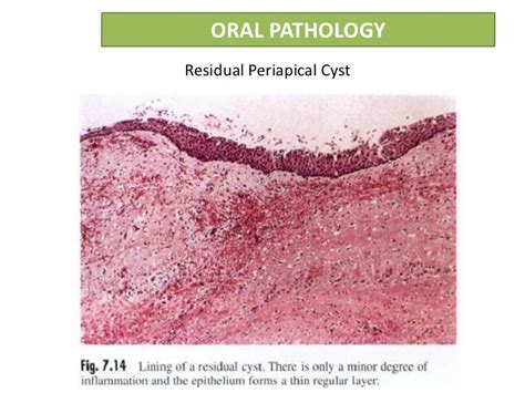 Radicular cyst or Periapical cyst