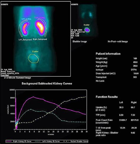 Pre-procedure (renal angioplasty) renal Tc 99-m DTPA scintigraphy with ...