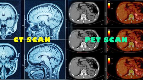 Pet Scan Vs Ct Scan Similarities And Differences | Hot Sex Picture