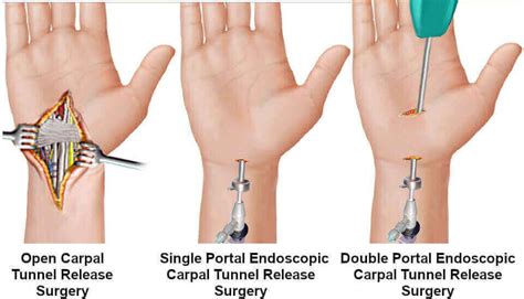 What Happens During Endoscopic Carpal Tunnel Surgery