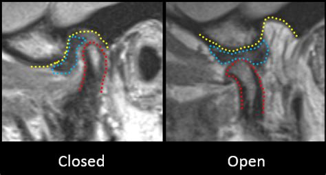 How To Diagnose Clicking Jaw Joints - Spear Education