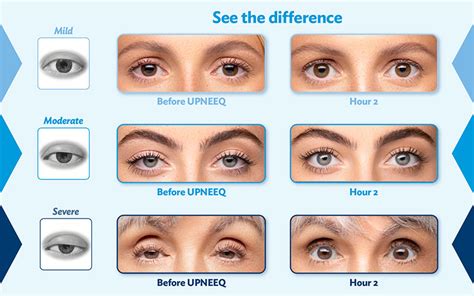 Droopy Eyelids: Causes, Treatments, Risks & More | Howard Ossen,Od