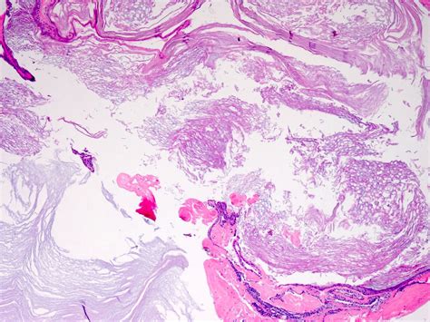 Epidermal Inclusion Cyst Histology