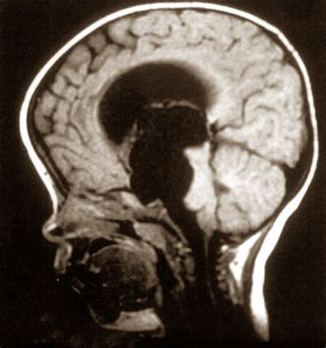 👉 Arachnoid Cyst - Pictures, Symptoms, Causes, Treatment (January 2022)