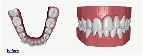 Byte Invisible Aligners Cost and Review | POPSUGAR Beauty UK