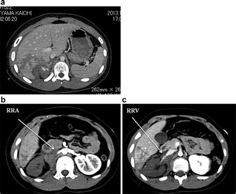 (a–c) CT scan showed a 5 cm liver laceration involving segments 5 and 6... | Download Scientific ...