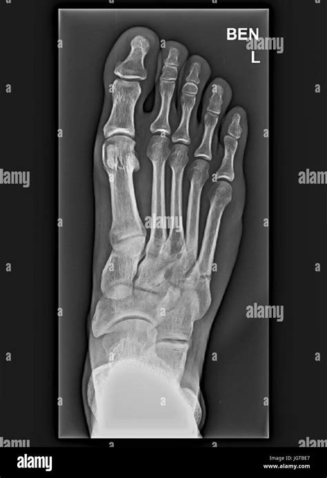 Foot xray hi-res stock photography and images - Alamy