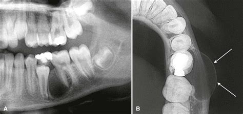 Radicular Cyst Radiograph