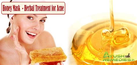 13 Most Effective Home Remedies for Acne You Must Try