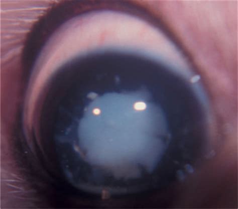 Hypermature Cataract Os