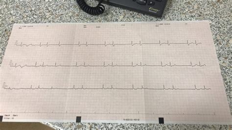 Debate with colleagues: Heartblock or sinoatrial block? : r/ECG