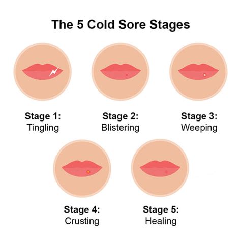 Cold Sores On Lips Early Stages