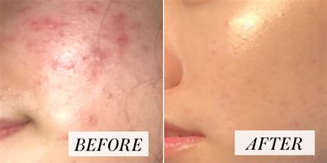 Woman's Skin-Care Routine for Acne Goes Viral - Before and After Photos | Allure