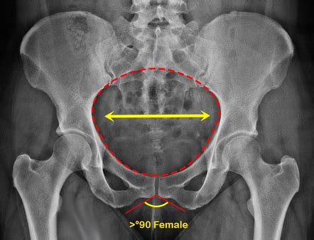 Pelvis (AP view) | Radiology Reference Article | Radiopaedia.org