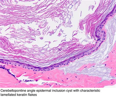 Pilar Cyst Histology