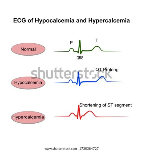 Hypocalcemia Ecg Changes