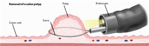 Colonoscopy - FV Hospital